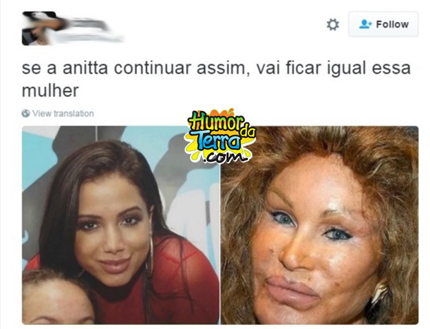 anitta-botox-humordaterra-2