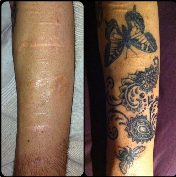 tatuagens-cicatrizes-6