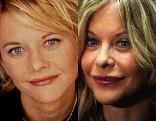celebridades-plasticas-fails-3